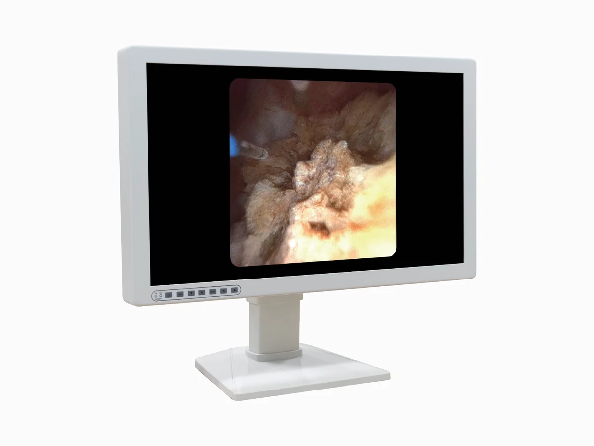 Monitor externo conectado al procesador PV300 de Pusen con imagen endoscópica